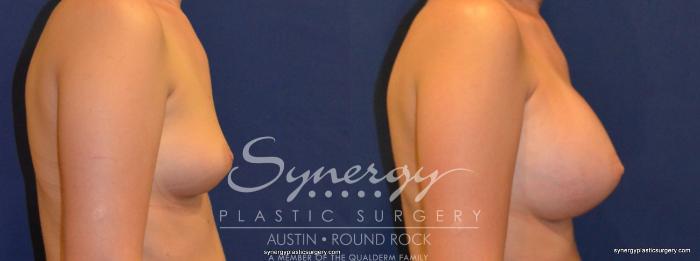 Before & After Breast Augmentation Case 211 View #2 View in Austin, TX