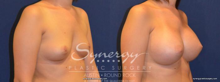 Before & After Breast Augmentation Case 211 View #3 View in Austin, TX