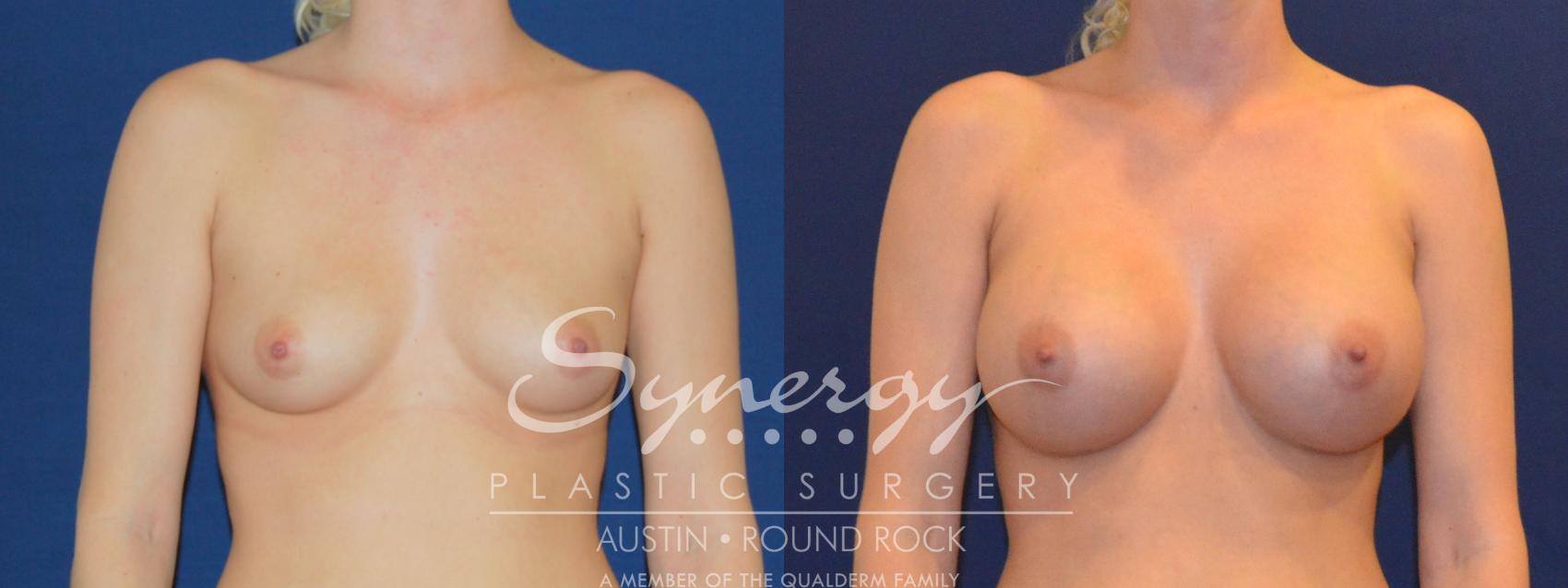 Before & After Breast Augmentation Case 212 View #1 View in Austin, TX