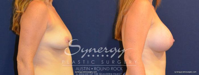 Before & After Breast Augmentation Case 215 View #2 View in Austin, TX