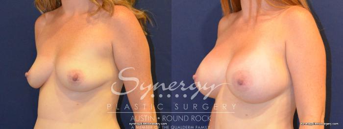 Before & After Breast Augmentation Case 215 View #3 View in Austin, TX