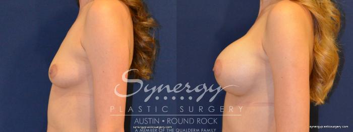 Before & After Breast Augmentation Case 218 View #2 View in Austin, TX