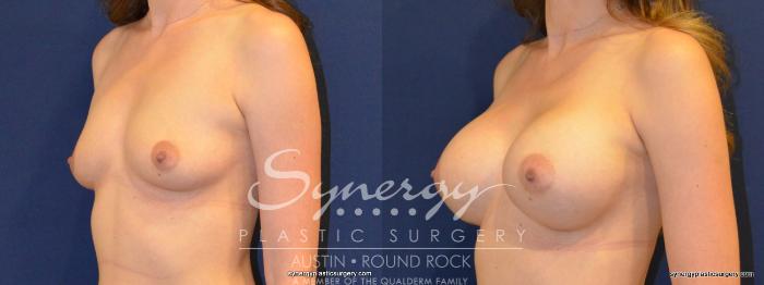 Before & After Breast Augmentation Case 218 View #4 View in Austin, TX