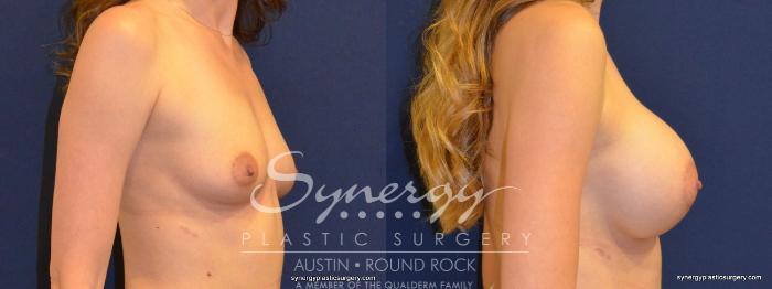 Before & After Breast Augmentation Case 218 View #5 View in Austin, TX