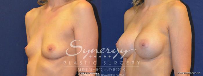 Before & After Breast Augmentation Case 220 View #2 View in Austin, TX