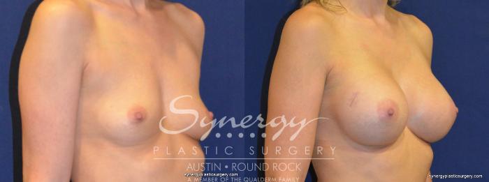 Before & After Breast Augmentation Case 220 View #3 View in Austin, TX
