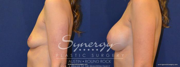 Before & After Breast Augmentation Case 220 View #4 View in Austin, TX