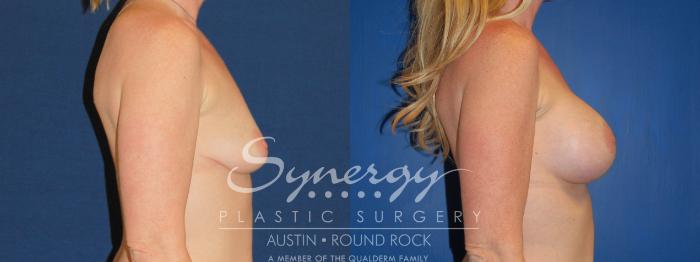 Before & After Breast Augmentation Case 221 View #1 View in Austin, TX
