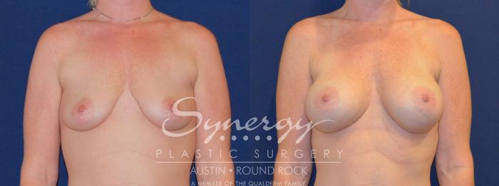 Before & After Breast Augmentation Case 221 View #2 View in Austin, TX