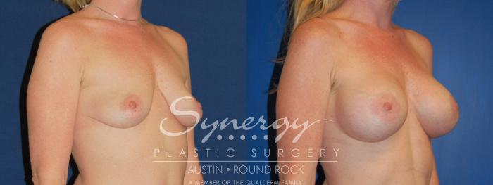 Before & After Breast Augmentation Case 221 View #3 View in Austin, TX
