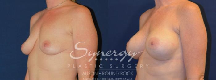 Before & After Breast Augmentation Case 221 View #4 View in Austin, TX