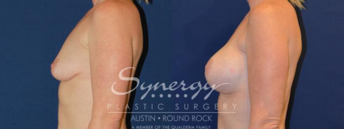 Before & After Breast Augmentation Case 221 View #6 View in Austin, TX