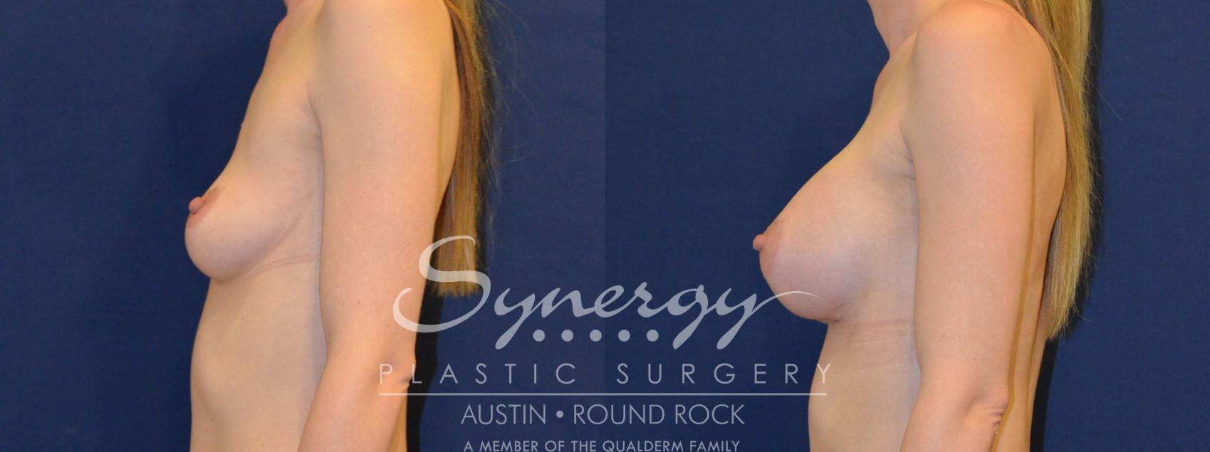 Before & After Breast Augmentation Case 222 View #1 View in Austin, TX