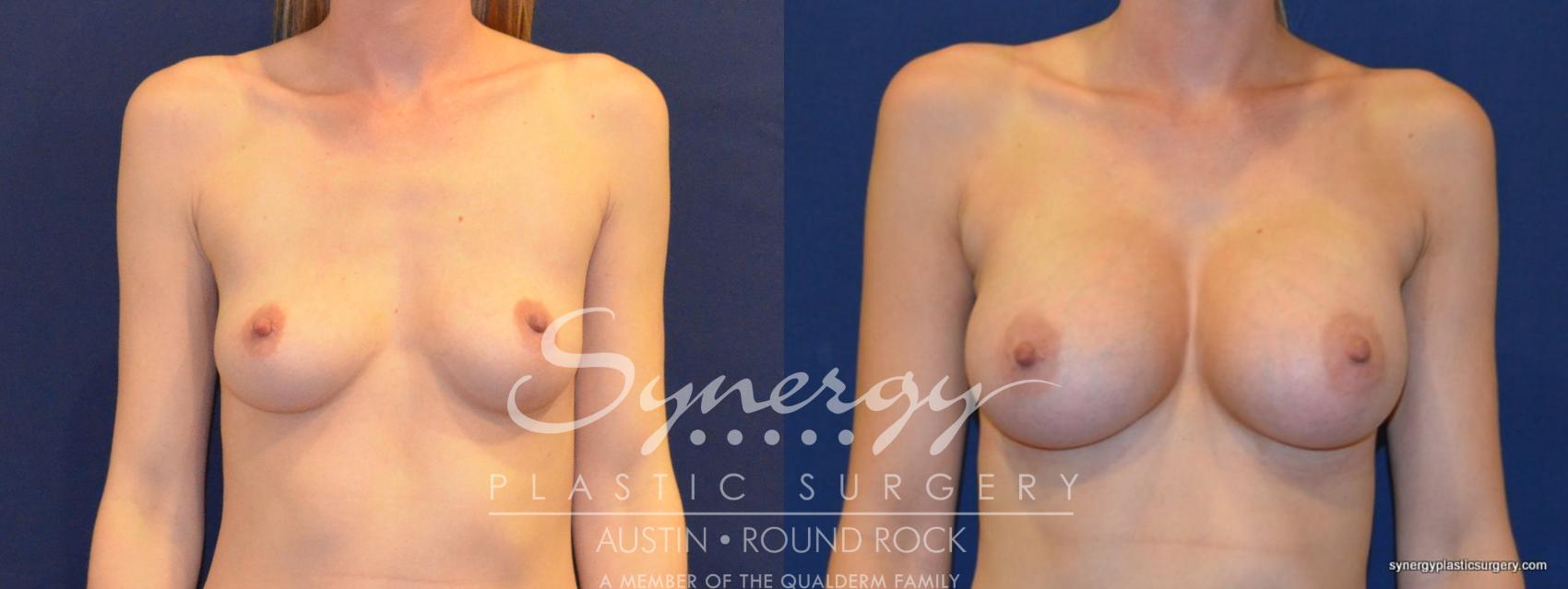 Before & After Breast Augmentation Case 222 View #2 View in Round Rock, TX