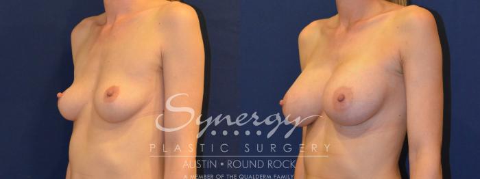 Before & After Breast Augmentation Case 222 View #3 View in Austin, TX