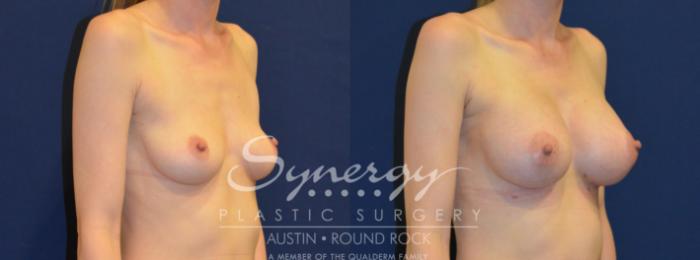 Before & After Breast Augmentation Case 222 View #4 View in Austin, TX
