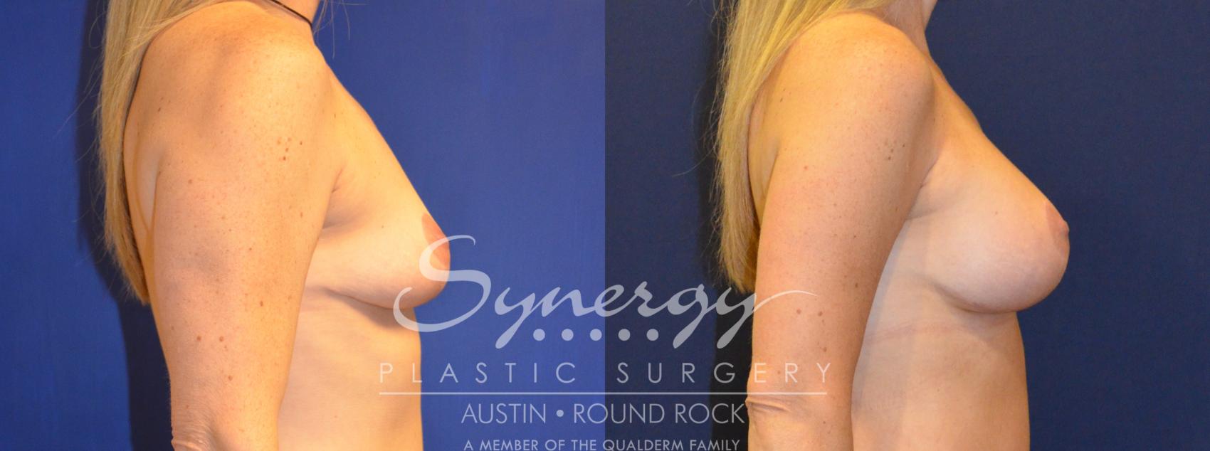 Before & After Breast Augmentation Case 224 View #1 View in Round Rock, TX
