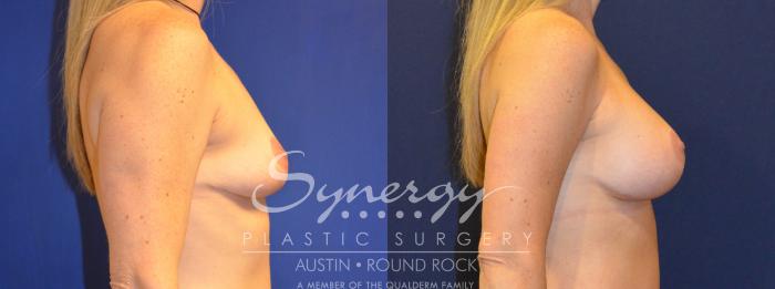 Before & After Breast Augmentation Case 224 View #1 View in Austin, TX