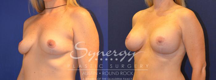Before & After Breast Augmentation Case 224 View #3 View in Austin, TX