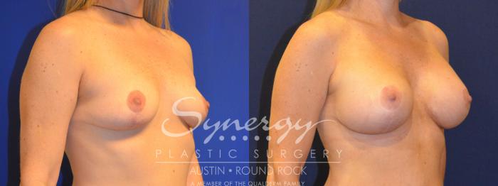 Before & After Breast Augmentation Case 224 View #4 View in Austin, TX