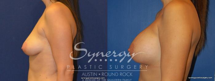 Before & After Breast Augmentation Case 228 View #2 View in Austin, TX