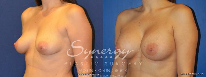 Before & After Breast Augmentation Case 228 View #3 View in Austin, TX