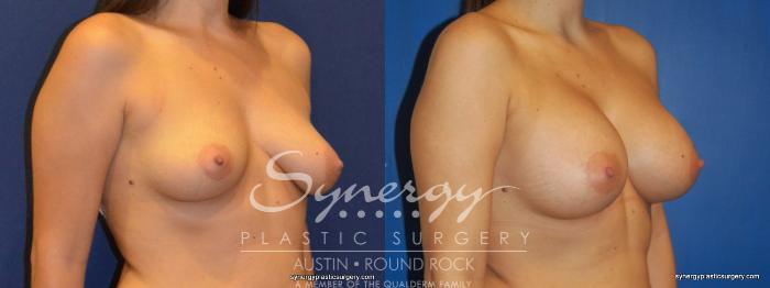 Before & After Breast Augmentation Case 228 View #4 View in Austin, TX