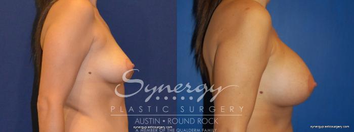 Before & After Breast Augmentation Case 228 View #5 View in Austin, TX