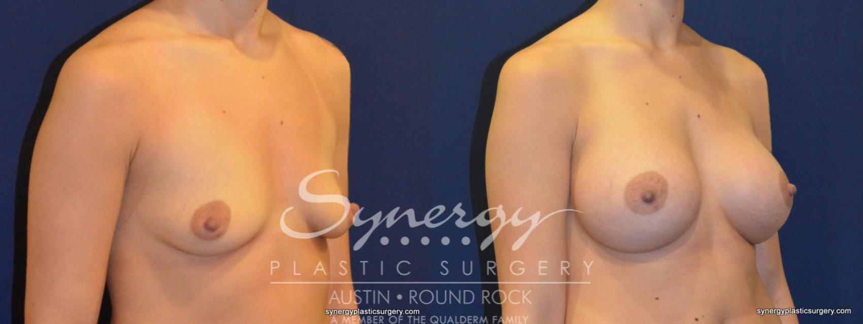 Before & After Breast Augmentation Case 235 View #1 View in Austin, TX