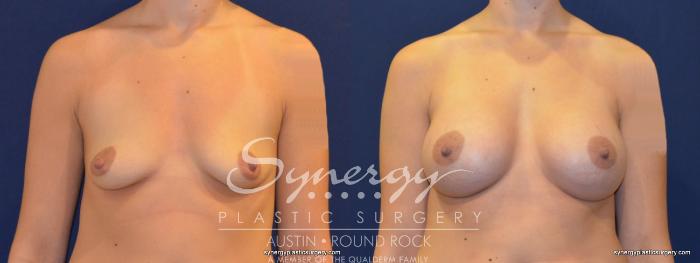 Before & After Breast Augmentation Case 235 View #2 View in Austin, TX