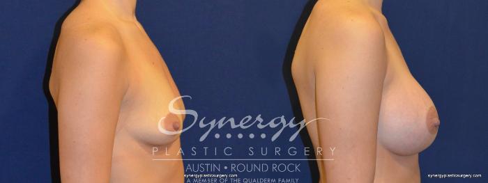 Before & After Breast Augmentation Case 235 View #3 View in Austin, TX