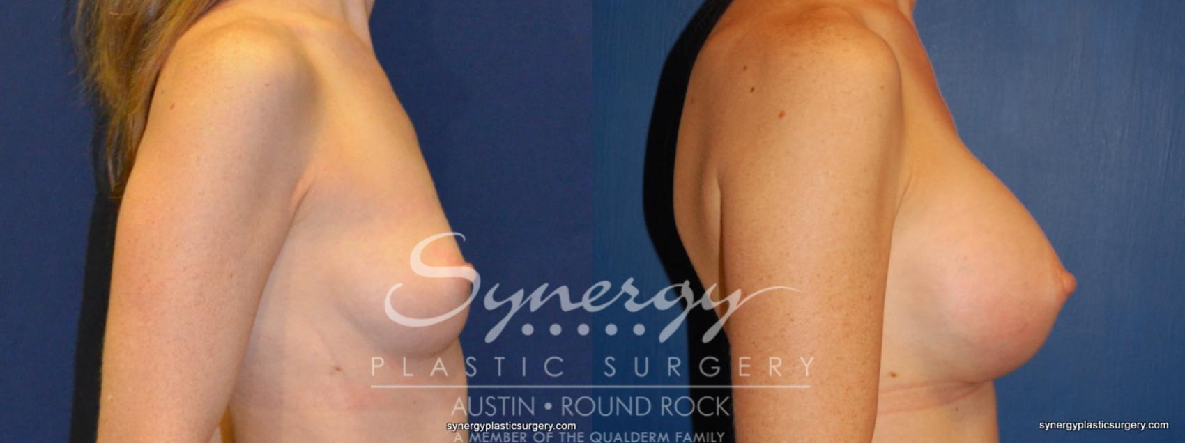 Before & After Breast Augmentation Case 245 View #1 View in Austin, TX