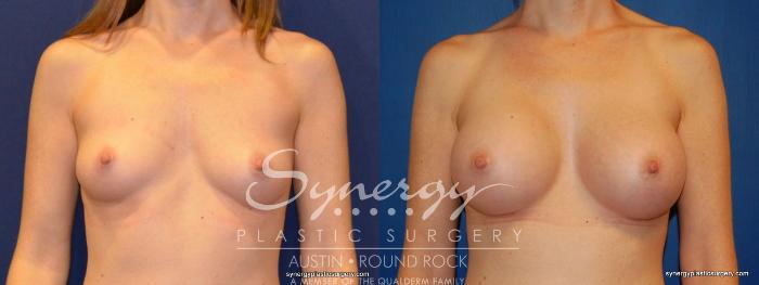 Before & After Breast Augmentation Case 245 View #2 View in Austin, TX