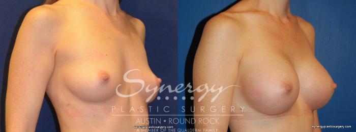 Before & After Breast Augmentation Case 245 View #3 View in Austin, TX