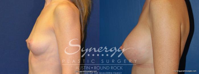Before & After Breast Augmentation Case 245 View #4 View in Austin, TX