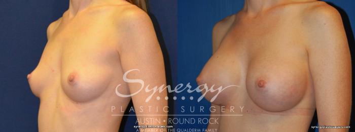 Before & After Breast Augmentation Case 245 View #5 View in Austin, TX