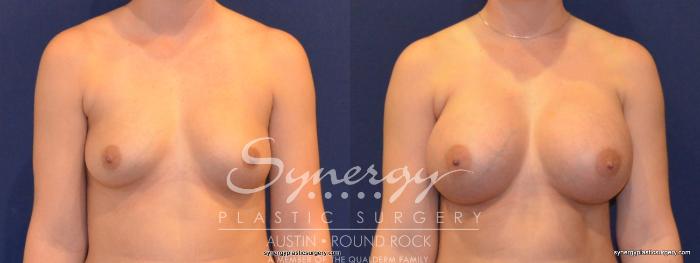 Before & After Breast Augmentation Case 249 View #1 View in Austin, TX