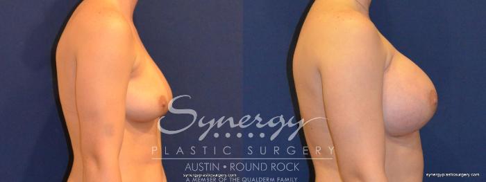 Before & After Breast Augmentation Case 249 View #2 View in Austin, TX