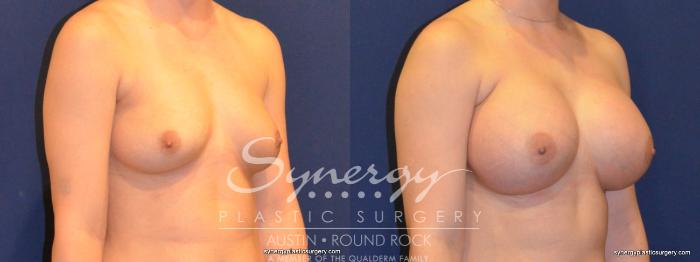 Before & After Breast Augmentation Case 249 View #3 View in Austin, TX