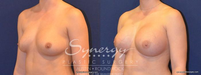 Before & After Breast Augmentation Case 249 View #4 View in Austin, TX
