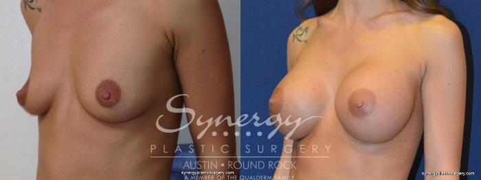 Before & After Breast Augmentation Case 250 View #1 View in Austin, TX