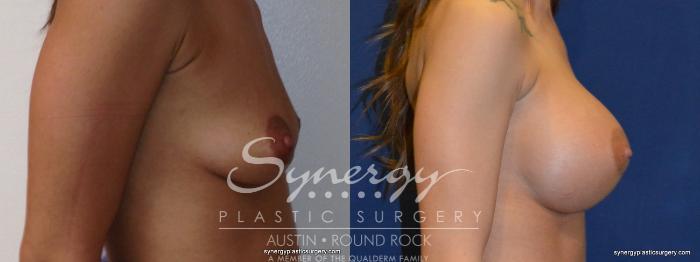 Before & After Breast Augmentation Case 250 View #2 View in Austin, TX