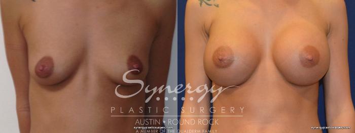 Before & After Breast Augmentation Case 250 View #3 View in Austin, TX