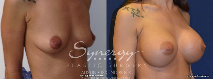 Before & After Breast Augmentation Case 250 View #4 View in Austin, TX
