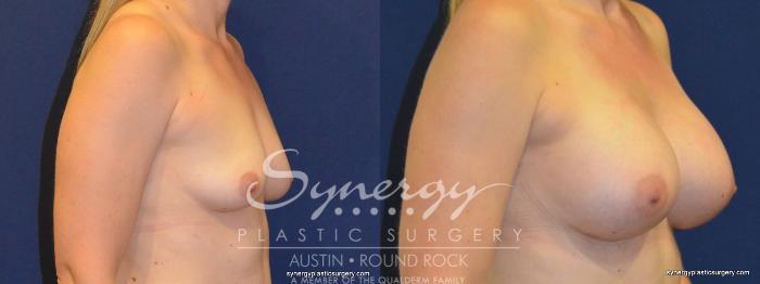 Before & After Breast Augmentation Case 255 View #2 View in Austin, TX