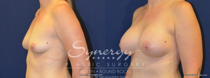 Before & After Breast Augmentation Case 255 View #3 View in Austin, TX