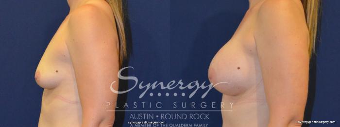 Before & After Breast Augmentation Case 255 View #4 View in Austin, TX