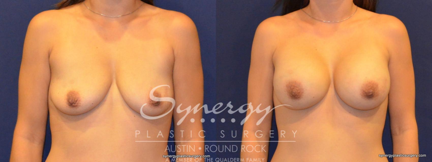 Before & After Breast Augmentation Case 259 View #1 View in Austin, TX