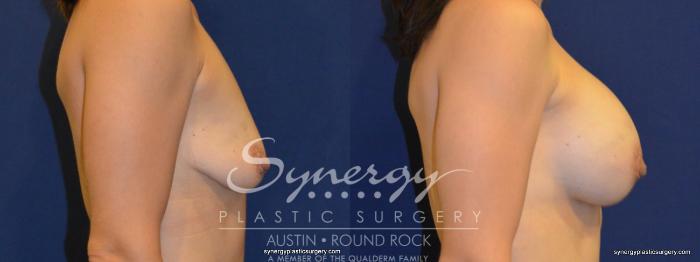 Before & After Breast Augmentation Case 259 View #3 View in Austin, TX