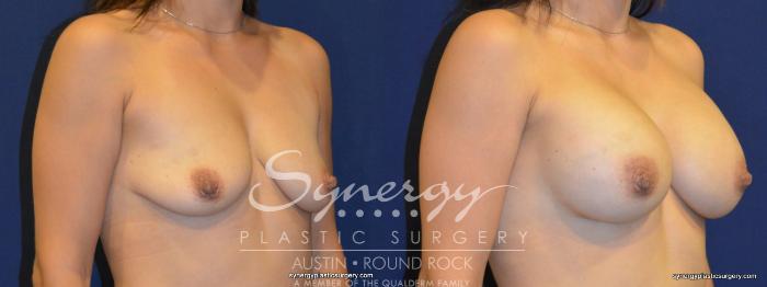 Before & After Breast Augmentation Case 259 View #4 View in Austin, TX